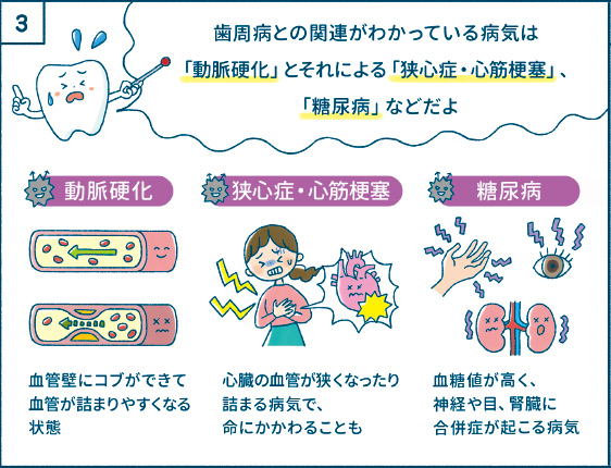 歯周病との関連がわかっている病気は「動脈硬化」とそれによる「狭心症・心筋梗塞」、「糖尿病」などだよ
